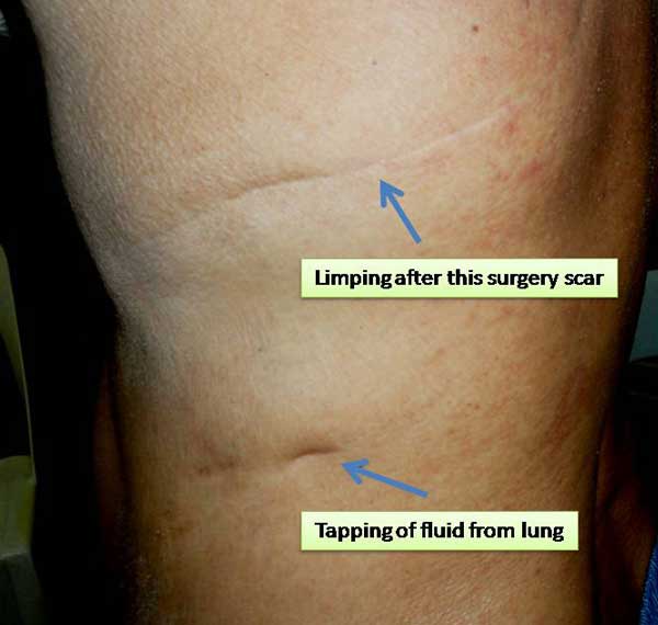 1-Limping-after-surgery