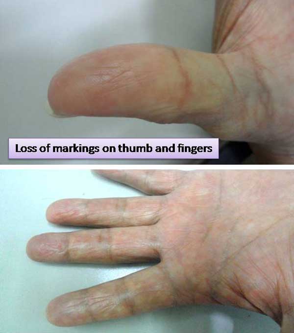 2-Loss-of-markings-on-thrmb