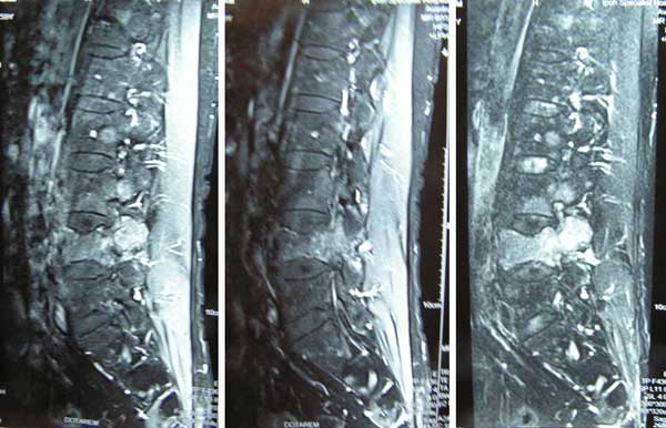 2 Bone-MRI