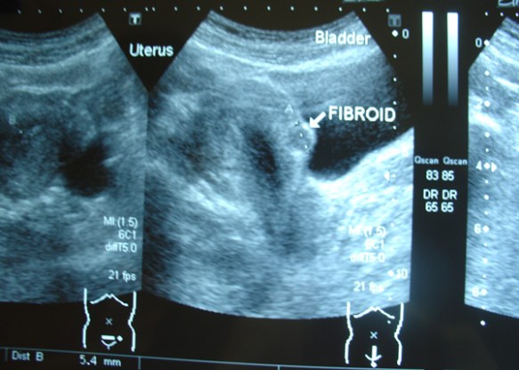 1-Fibroid