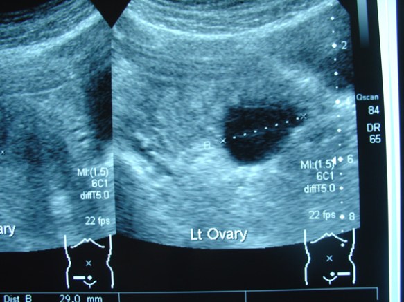 3-Left-ovary