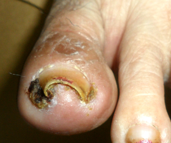 Side-effect-of-Iressa-toe-n