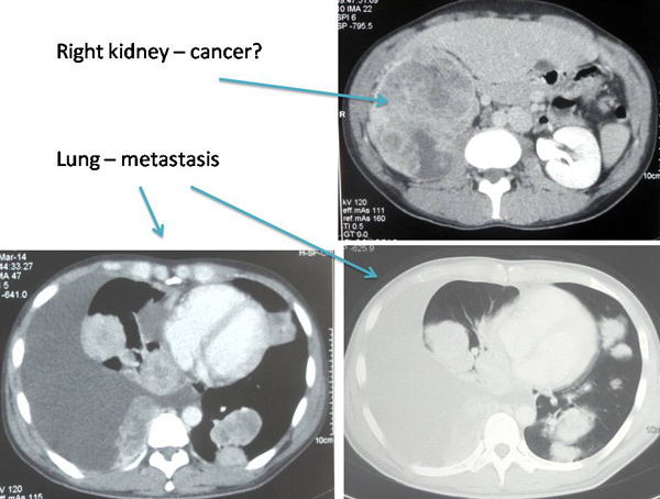1 Composite-Kid-Lung