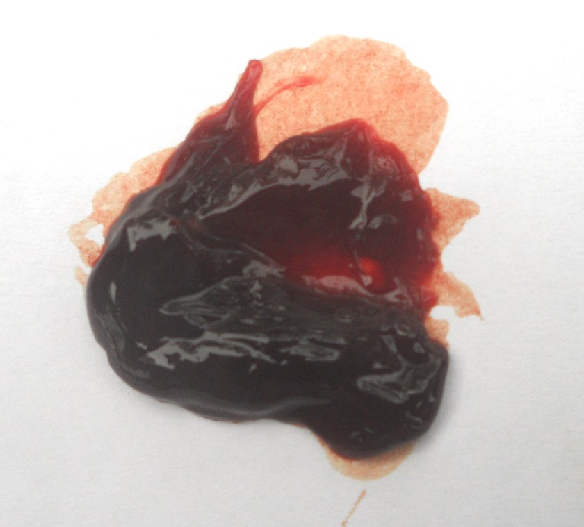 3 Blood clot from urine