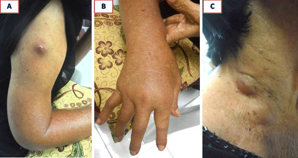 Composite-Breast-S542