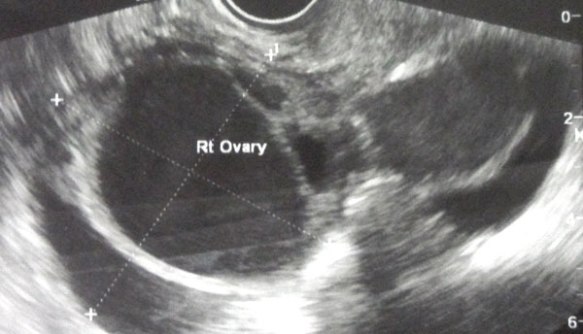 3-Right-ovary