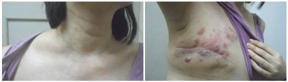 pt-1-swollen-neck-and-recurrence